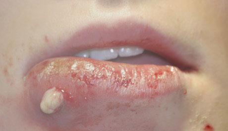 mrsa-staph-infection (1)