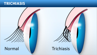 trichiasis-324x184